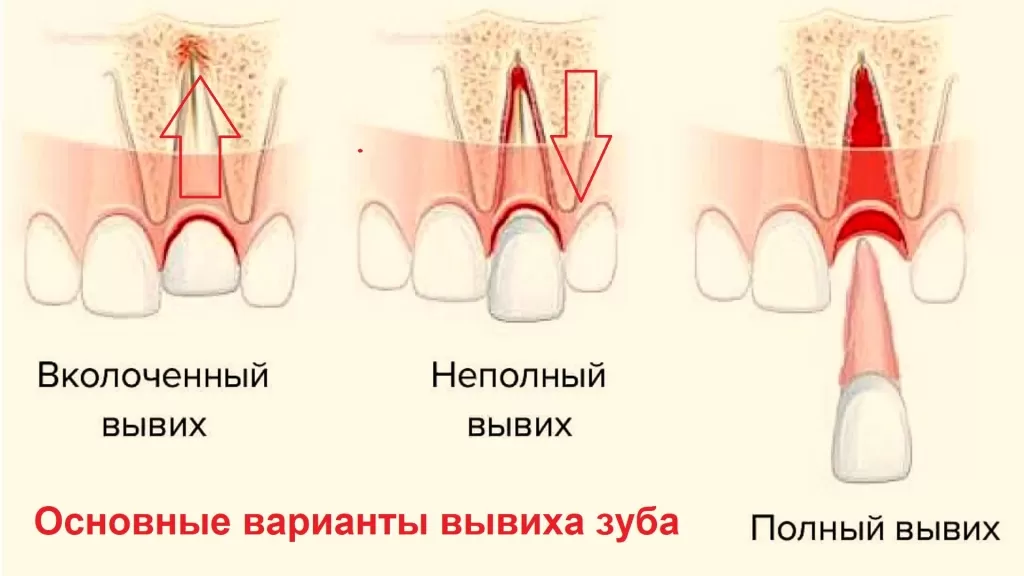 Вывих зуба - это состояние, при котором зуб выходит из своего естественного положения в зубном ряду из-за травмы или сильного удара.