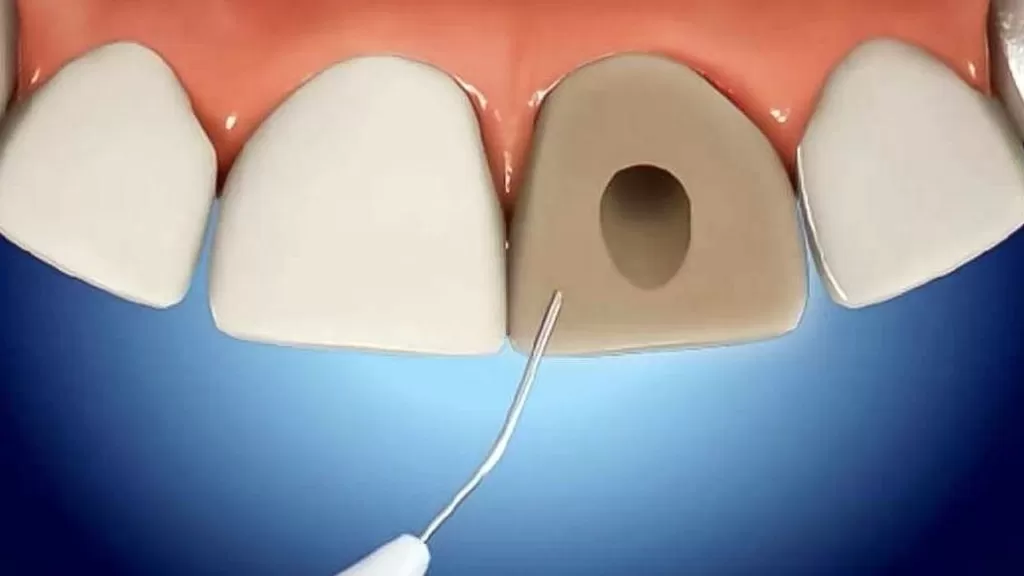 Так проводится внутриканальное отбеливание зубов