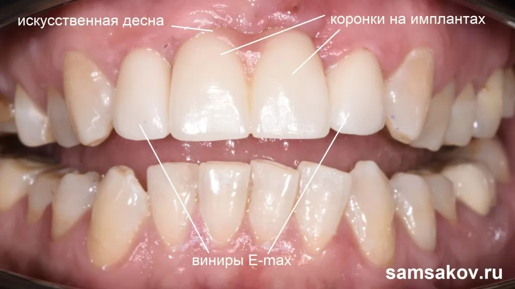 Длинные керамические передние зубы органично вписались в верхний зубной ряд, немного удлинить их в процессе протезирования было правильным решением