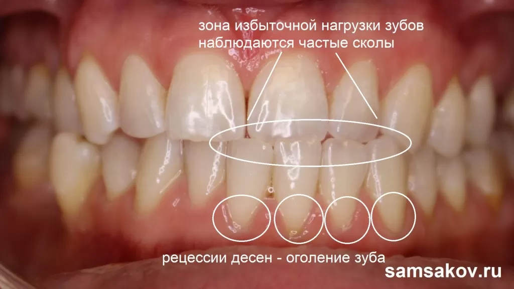Рецессии десен и избыточная нагрузка на эти зубы в результате мезиальной окклюзии