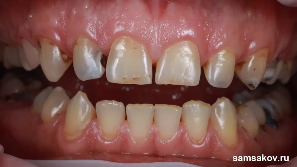 Зубы поражены кариесом буквально до корней