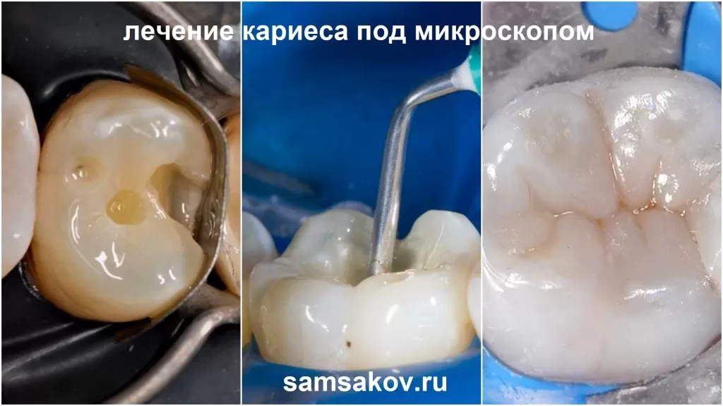 На фото - лечение кариеса и реставрация зуба под микроскопом