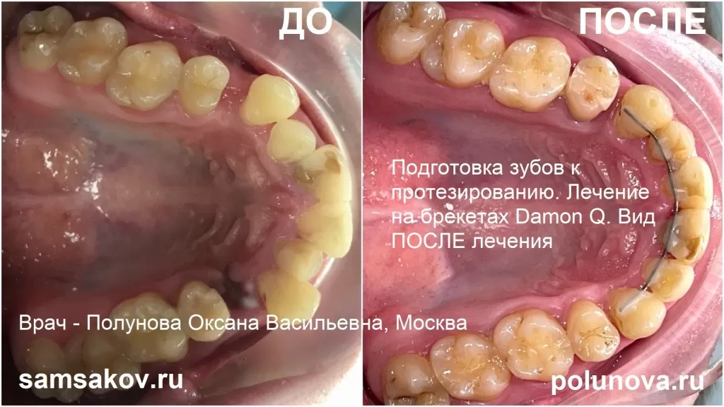 Так выглядят зубы верхней челюсти до и после лечения на брекетах Damon Q