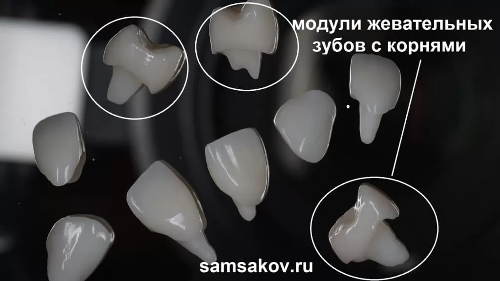 Фото различных зубных вкладок