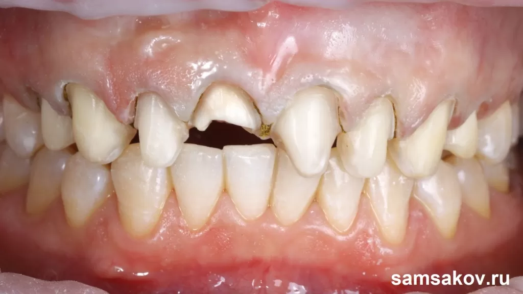 Фото зубов после обточки перед установкой виниров
