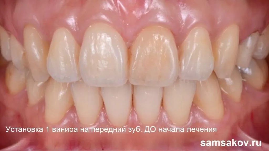 Как всего 1 винир на 1 зуб помог вернуть красивую улыбку пациентке. Ортопед Тарасов Алексей Анатольевич