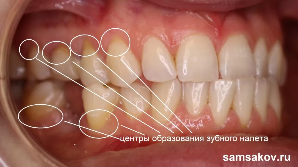 Образование зубного налета при мезиальном прикусе особенно заметно в области жевательных зубов