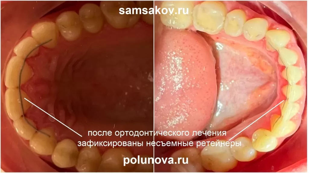 Результаты ортодонтического лечения были зафиксированы с помощью проволочных ретейнеров как на верхних, так и на нижних зубах.