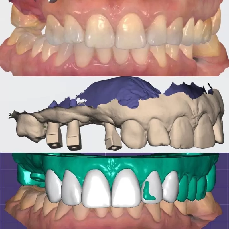 С развитием компьютерных технологий и цифрового сканирования диагностическая модель зубов может быть получена в виде компьютерной модели в 3D