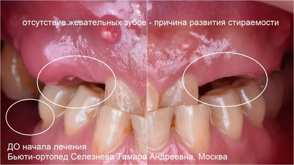 Отсутствие жевательных зубов может послужить началом развития патологической стираемости зубов