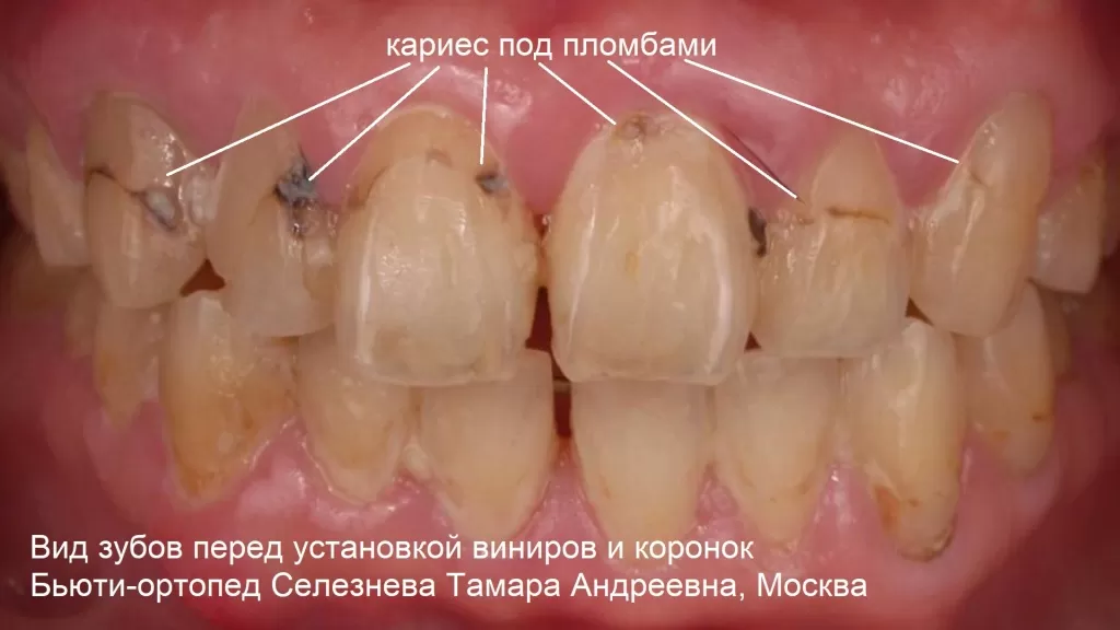 Вид зубов когда много кариеса и кариес эмали