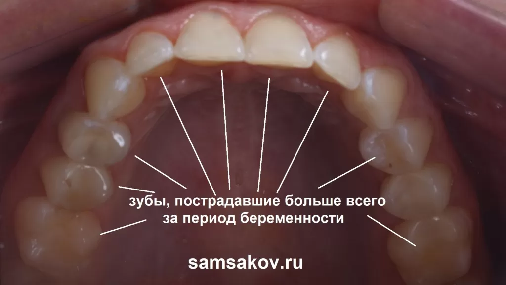 Зубы, пострадавшие больше всего за период беременности из-за дефицита кальция в организме