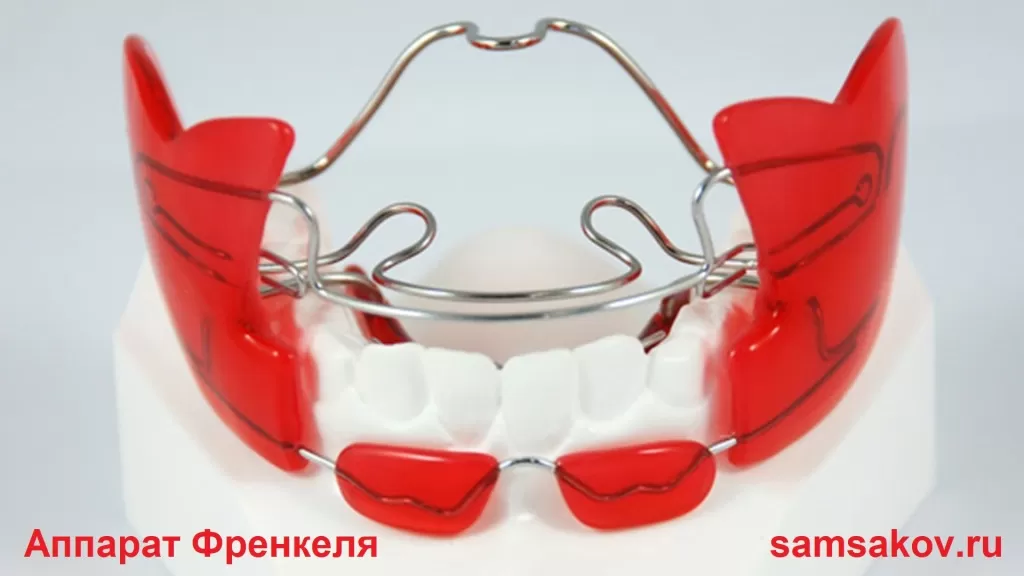 Аппарат Френкеля (также известный как ортодонтический аппарат Френкеля) - это ортодонтическое устройство, используемое для коррекции различных аномалий прикуса и расстановки зубов, особенно у детей и подростков