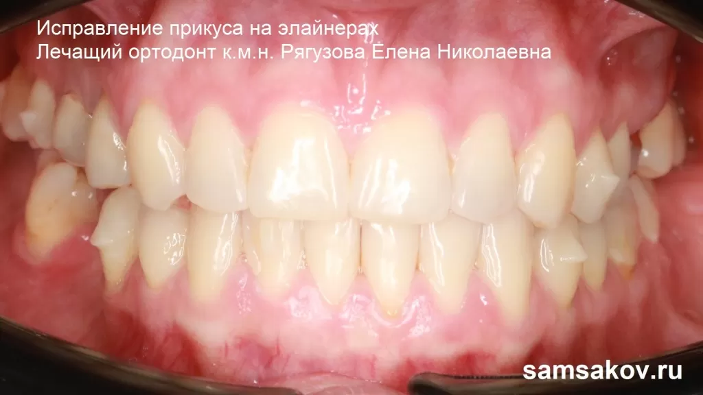 Имплантация и протезирование зубов, если в 27 лет у пациента уже мезиальный прикус