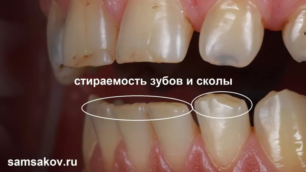 Фото стираемости зубов и сколов на щубах