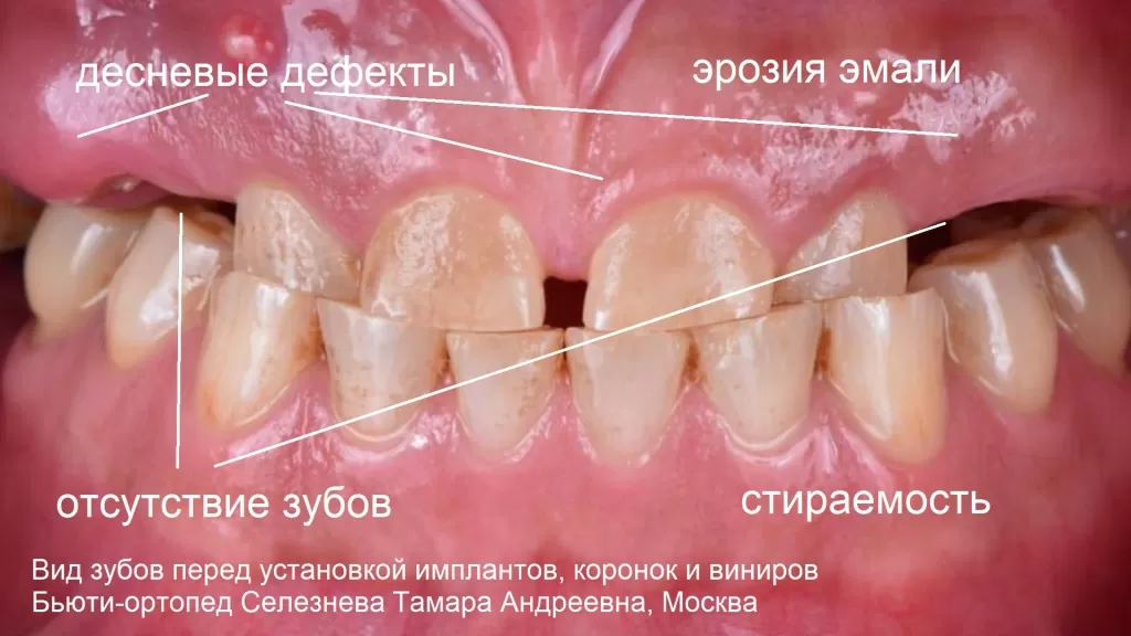 Отсутствие и стираемость зубов – не повод для расстройства, когда есть импланты, коронки и виниры
