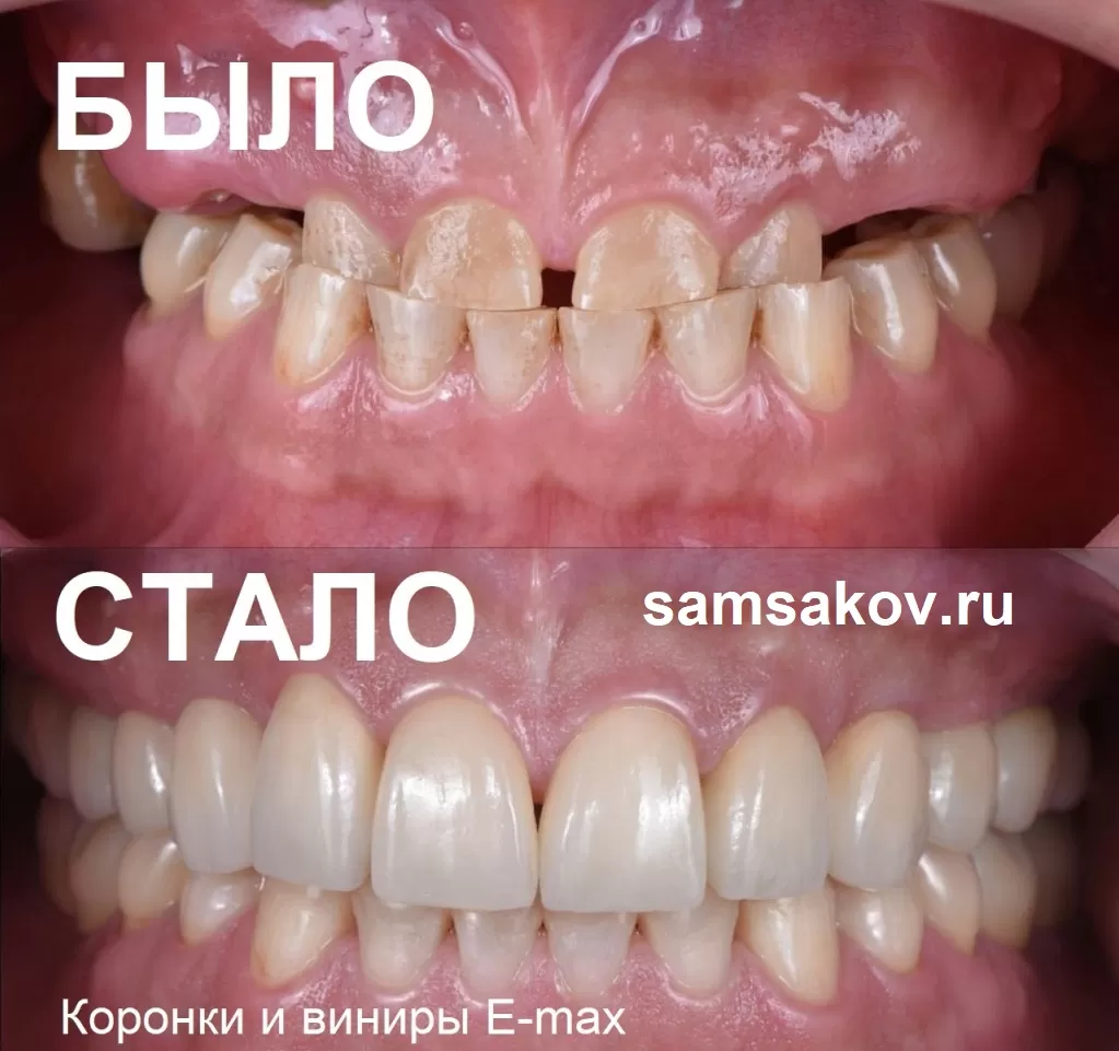 Как быстро остановить стираемость зубов? Нужно в первую очередь восстановить жевательные зубы.