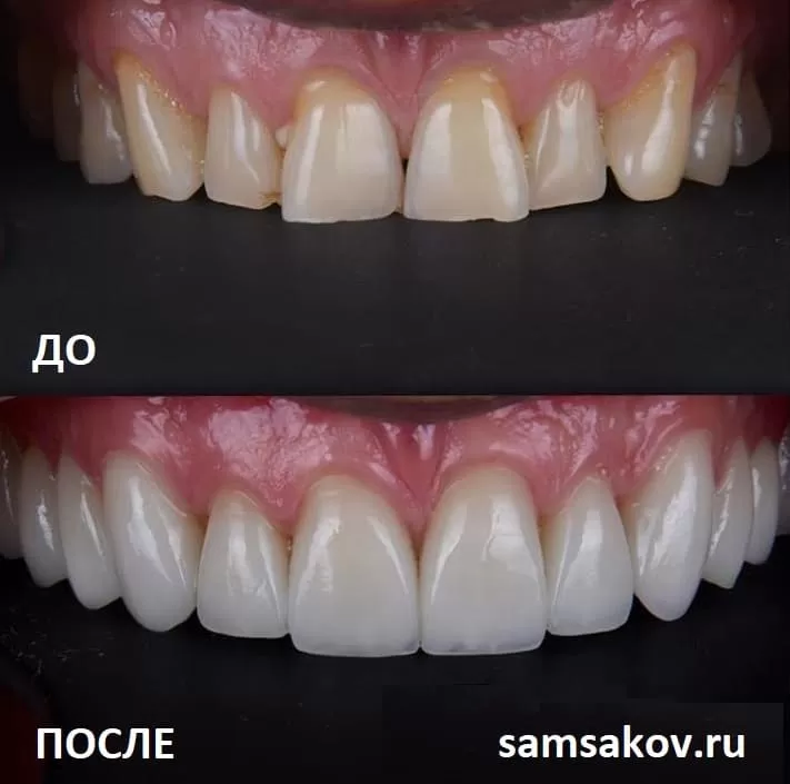 Керамические виниры для зубов 