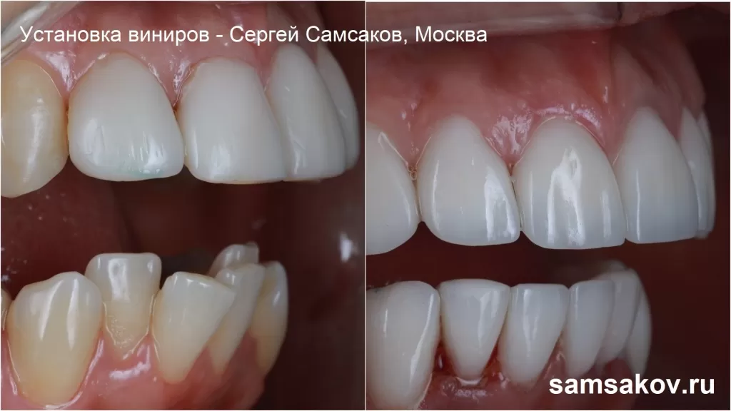 Вид зубов справа после установки виниров на зубы