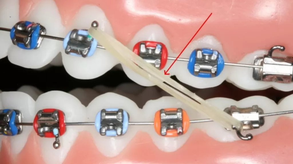 Брекеты вытязивают зуб с помощью специальных резиновых тяг