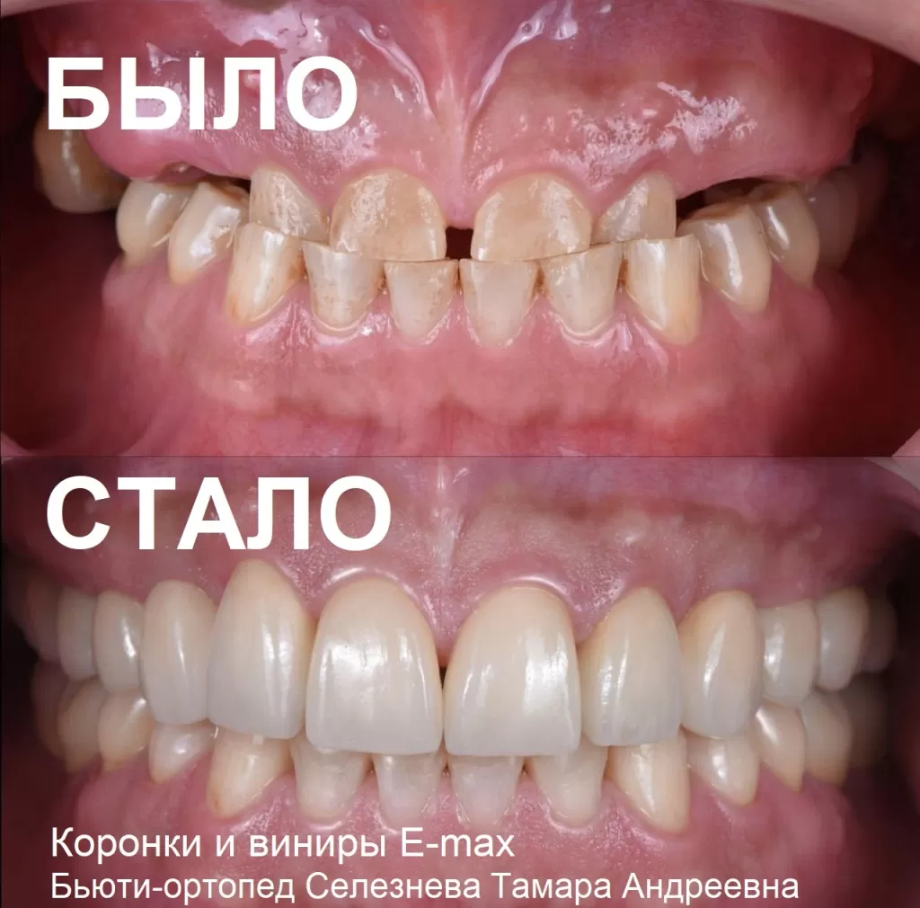 Как быстро остановить стираемость зубов? Нужно в первую очередь восстановить жевательные зубы.