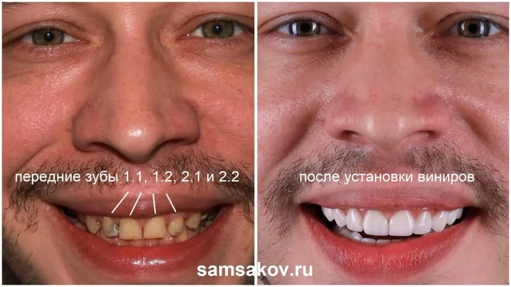 Передние зубы 1.1, 1.2, 2.1. и 2.2 успешно покрыты керамическими винирами. Смотрится очень красиво.