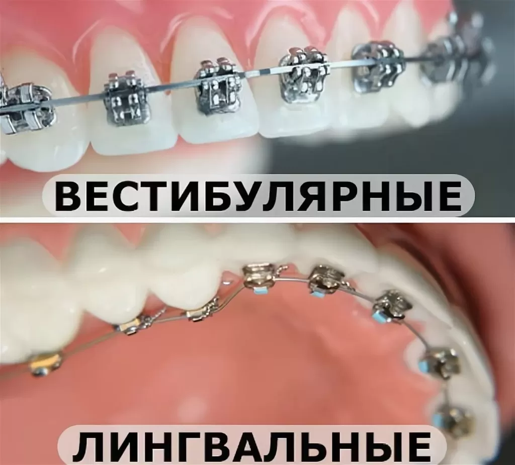 Брекеты - общеупотребимый термин сложных ортодонтических брекет-систем. Являются основным и центральным элементом этих систем, который используется в ортодонтии для коррекции положения зубов и выравнивания прикуса.