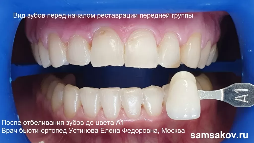 Так выглядят зубы после отбеливания с исходного цвета А3 до А1. Теперь приступаем к реставрации композитом передних зубов. Врач - Устинова Елена Федоровна, Москва
