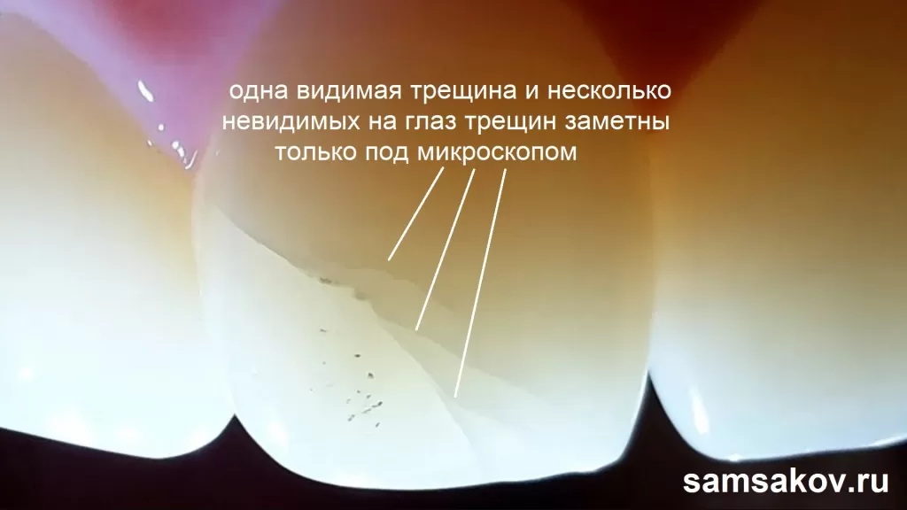 Трещины на зубах очень часто не видны простым невооруженным глазом. Только под микроскопом.