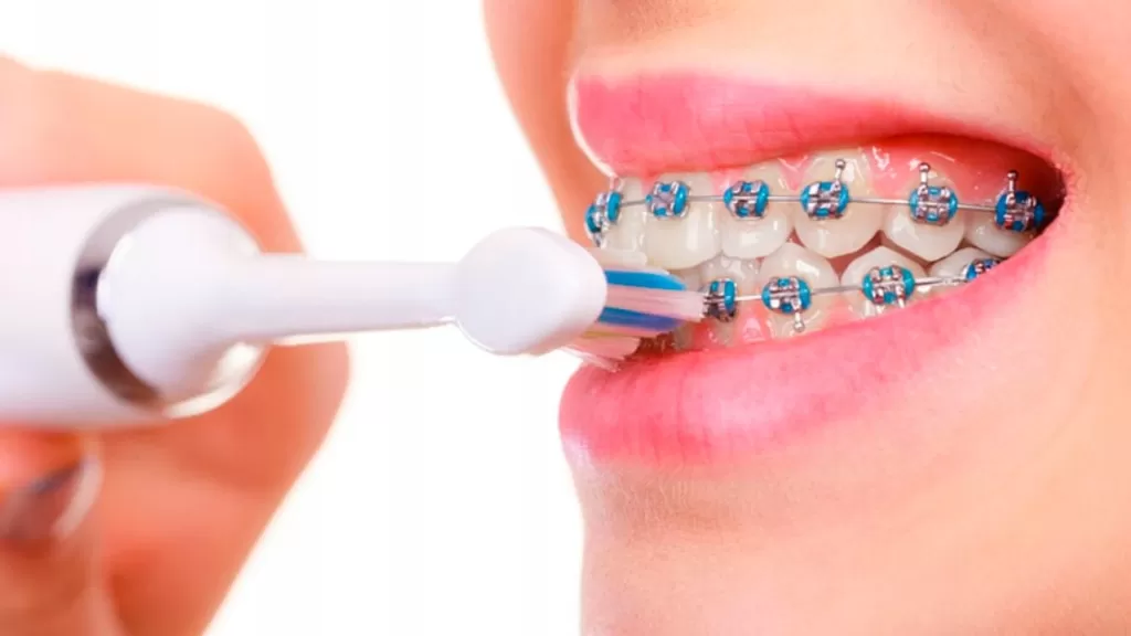 Электрическая зубная щетка может применяться и при ношении брекетов