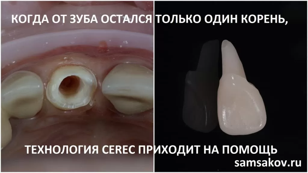 Даже если остался только лишь корень зуба, то восстановить этот зуб можно за 1 час по технологии Cerec