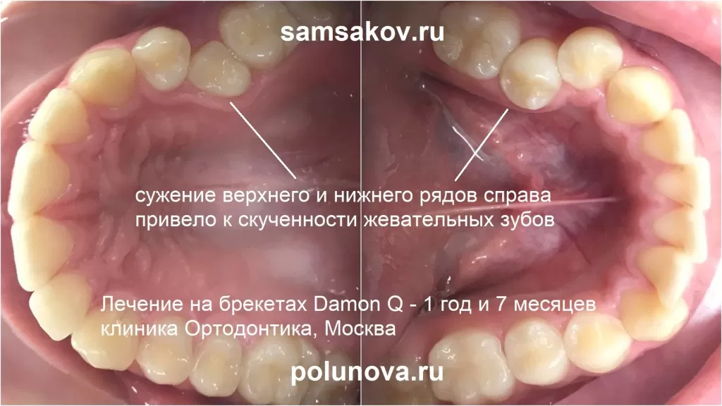 Сужение зубов на верхней и нижней челюсти, фото