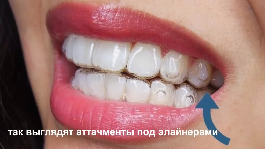 Аттачменты в ортодонтии - это специальные элементы, которые используются в ортодонтическом лечении для улучшения эффективности передвижения зубов и достижения желаемого результата