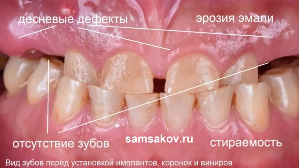 Стираемость зубов на фоне отсутствия жевательной группы зубов 