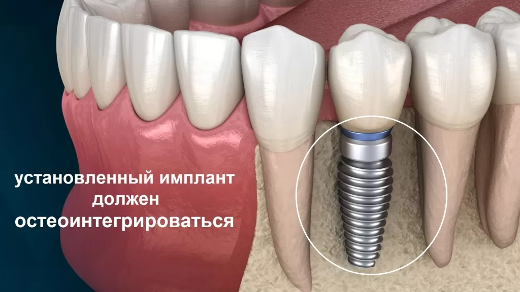 При стоматологической остеоинтеграции имплантат, обычно изготовленный из титана, внедряется в кость, где он постепенно соединяется с окружающей костной тканью.