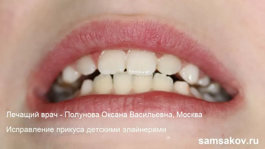 Так выглядят зубы Андрея после элайнеров. Лечащий врач - Полунова Оксана Васильевна, Москва