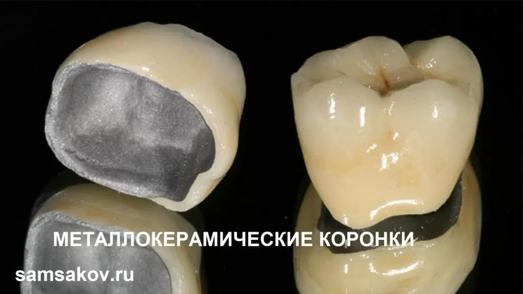 Так выглядит металлокерамическая коронка на жевательный зуб
