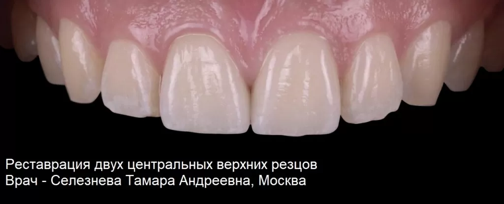 Реставрация передних зубов коронками. Лечащий врач - Селезнева Тамара Андреевна, Москва