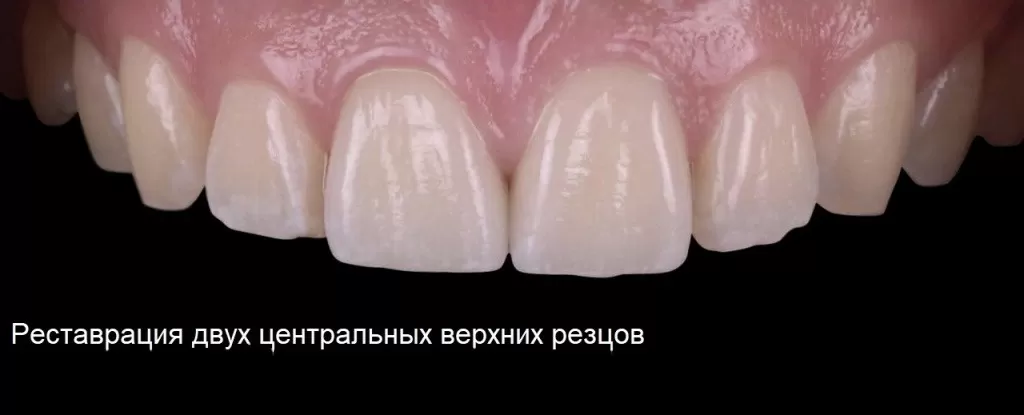 Виниры на передние зубы