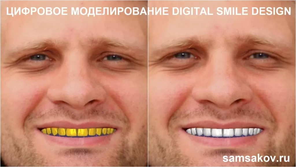 Вид цифровой улыбки Карнея, его будущие виниры. Лечащий стоматолог-ортопед Самсаков Сергей, клиника Церекон