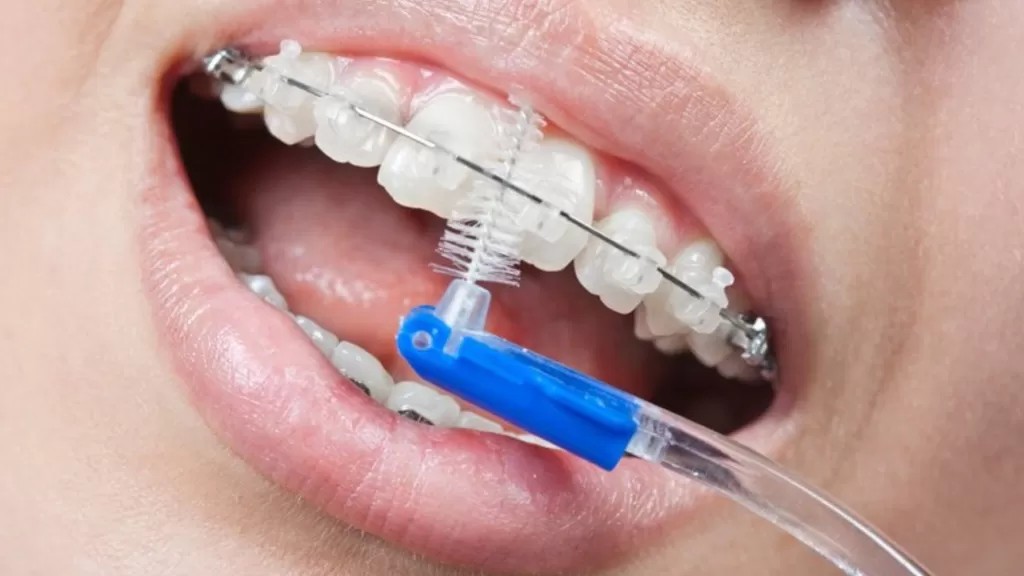 Ершики для зубов могут быть разных размеров, чтобы соответствовать различным межзубным пространствам и типам ортодонтических аппаратов.