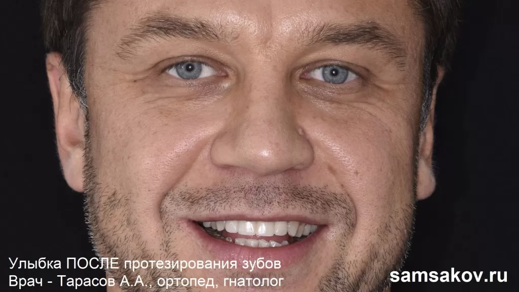 Так выглядит мужская улыбка после протезирования передних верхних зубов. Врач - ортопед Тарасов Алексей Анатольевич, Москва 