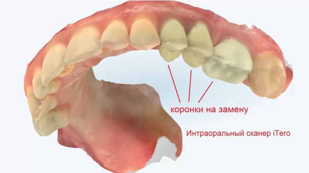 Сканирование жевательных зубов вместо гипсовых слепков