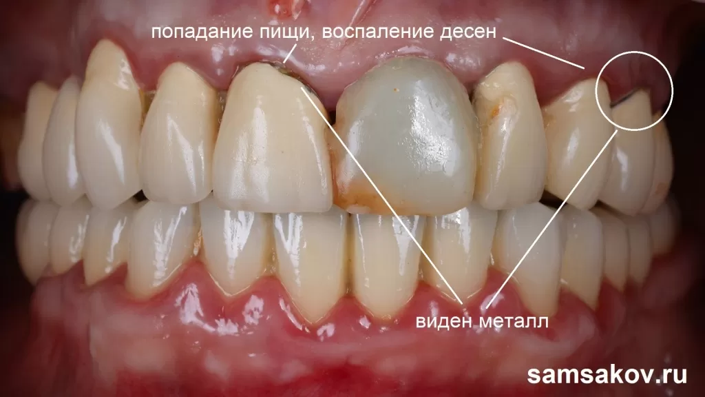 Металлокерамический мост на 10 зубов пришел в негодность