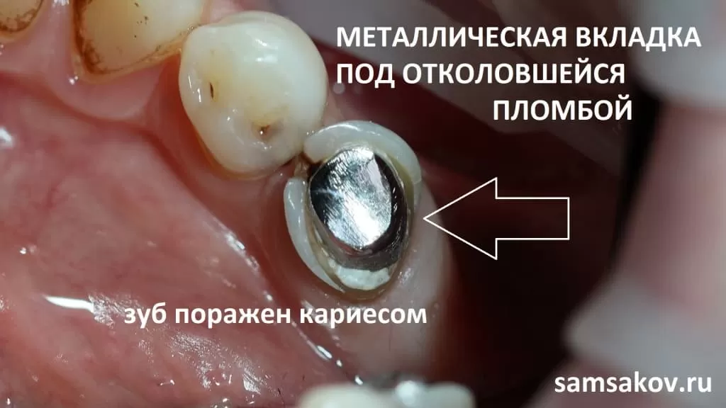 На этом зубе 3.5 изначально была пломба, в зуб установлена металлическая культевая вкладка