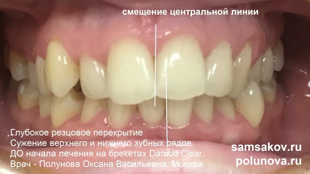 Смещение центральной линии зубов при глубоком прикусе