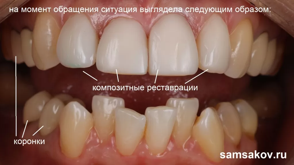 Установка виниров на кривые зубы возможна. Ортопед Сергей Самсаков, Москва