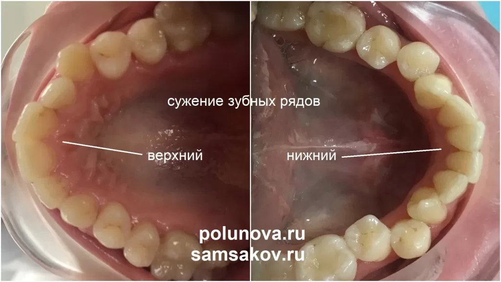 Сужение зубных рядов на верхней и нижней челюсти при глубоком прикусе