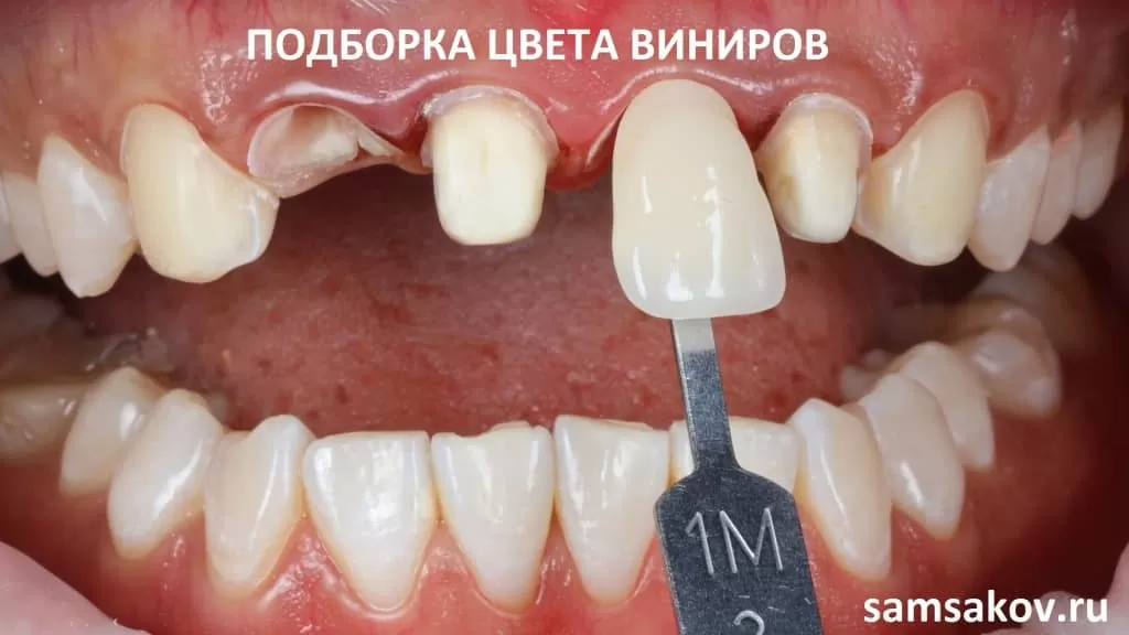 Реставрация зубов цвет виниров