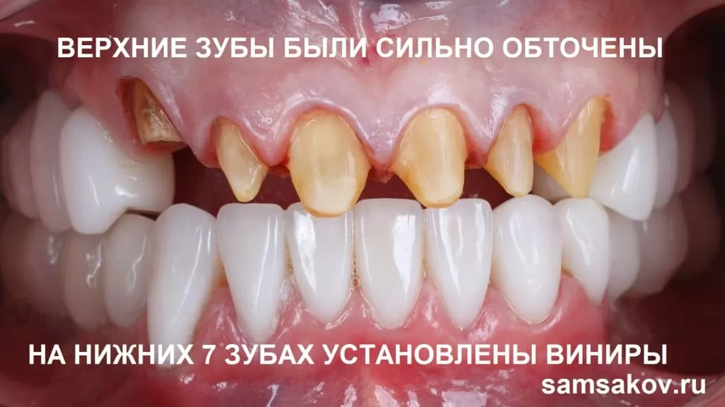фото сточенных зубов после снятия старых виниров